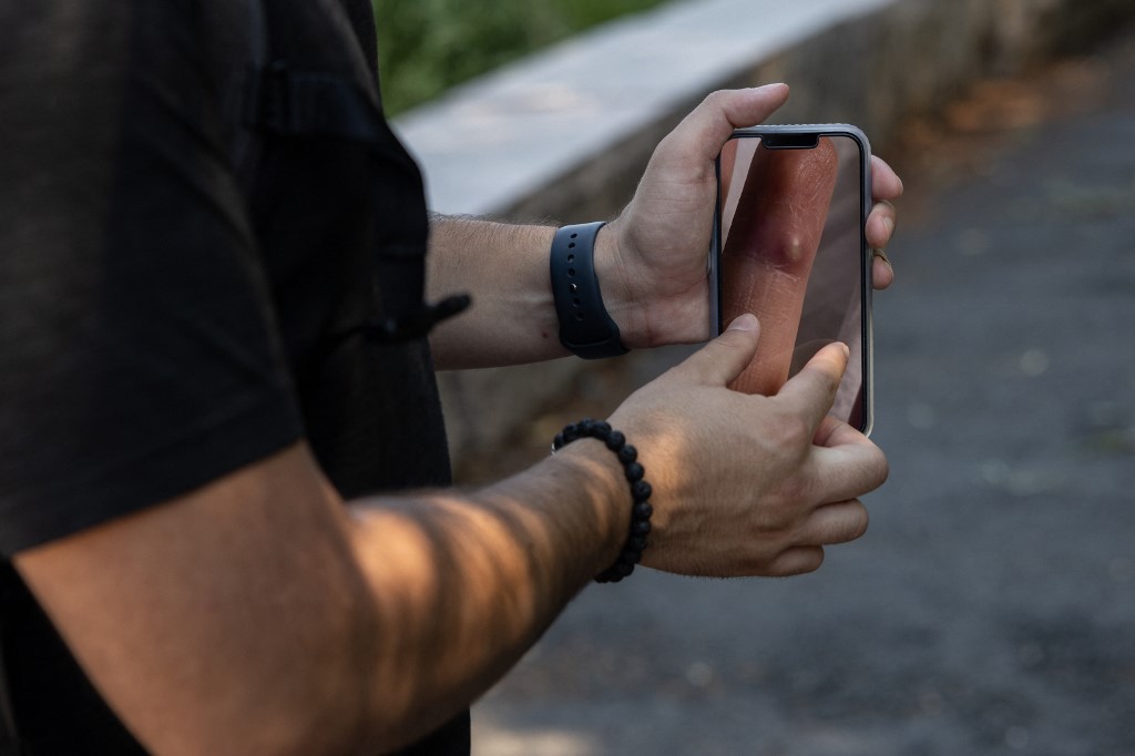 "No le deseo a nadie lo que pasé": habla un hombre recién recuperado de la viruela del mono | Internacionales