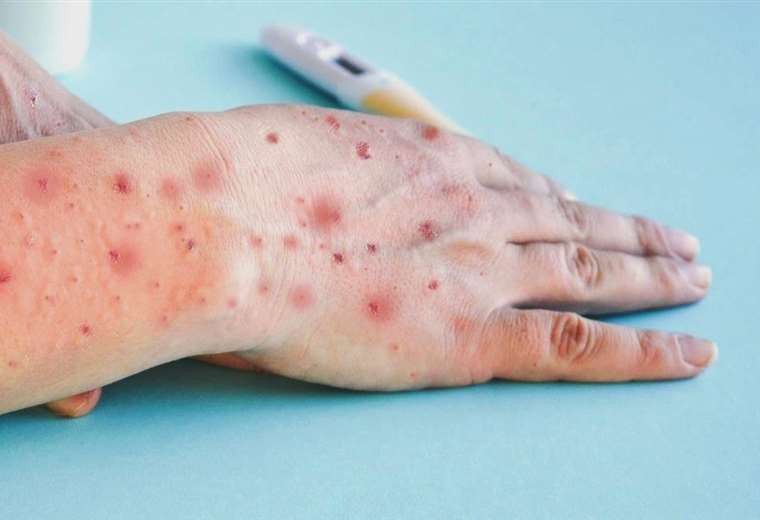 Perú: murió por septicemia una persona infectada con viruela del mono | Internacionales