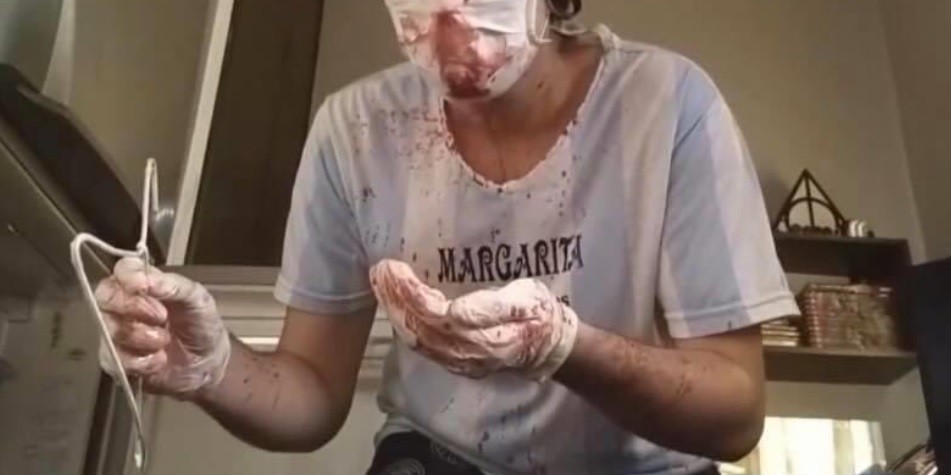 Atendieron de urgencia a un hombre que quiso hacerse una rinoplastía siguendo un tutorial de Youtube | Internacionales