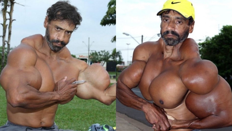 Murió el Hulk brasileño: se inyectó aceite durante años para aumentar sus músculos | Internacionales