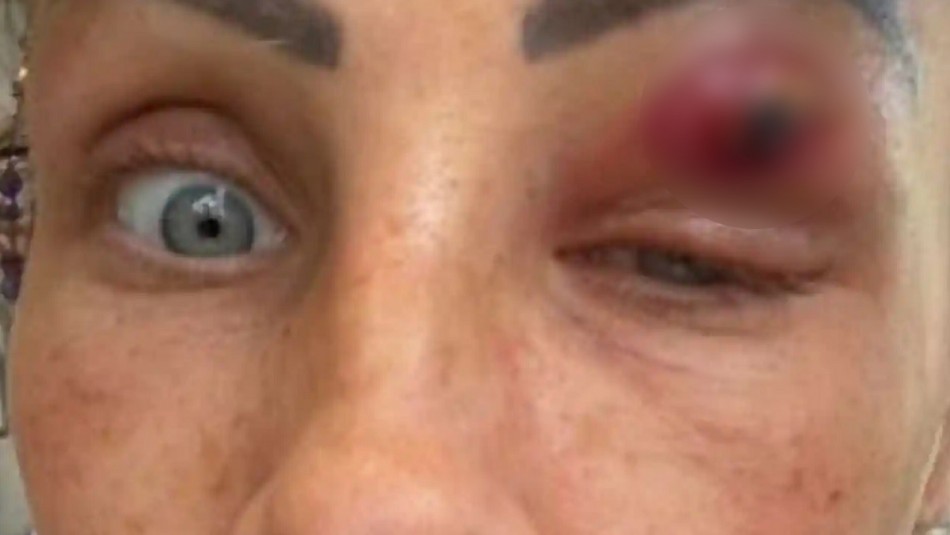 Mujer creyó que tenía un grano en su párpado pero terminó expulsando un parásito | Internacionales