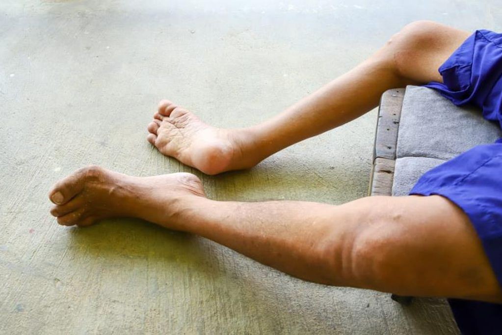 Reino Unido reactiva una campaña de vacunación contra la polio en niños de entre 1 y 9 años | Internacionales