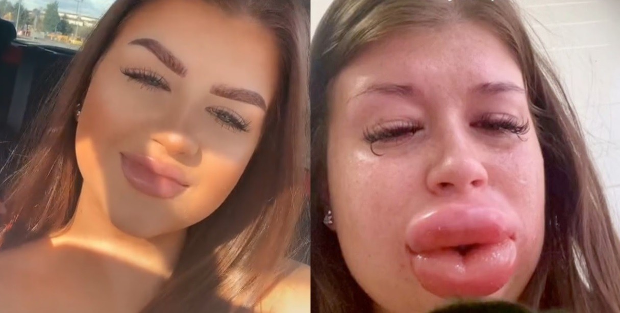 Rompió en llanto al comprobar que su cara se deformaba por un tratamiento estético fallido | Internacionales