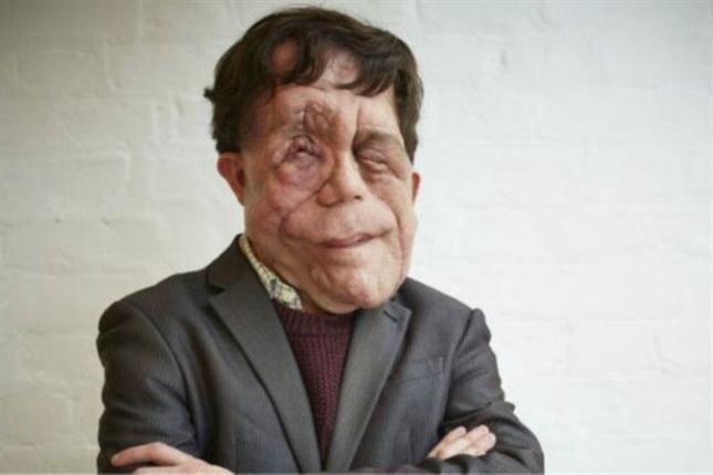 El drama de vivir con una desfiguración facial: "Me han llamado mutante deforme" | Curiosidades