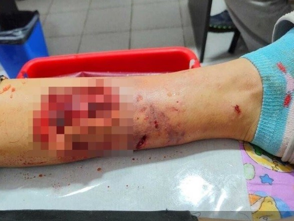 "La arrastró dándole varias vueltas": un pitbull suelto atacó a una nena en la calle y tuvieron que operarla de urgencia | Actualidad