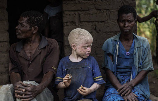 Brujería en Africa, el cruento destino de los albinos negros | Curiosidades