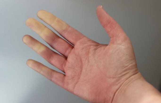 Indemnización millonaria para una paciente que tuvo grave consecuencias en sus manos por demoras en una medicación | Actualidad