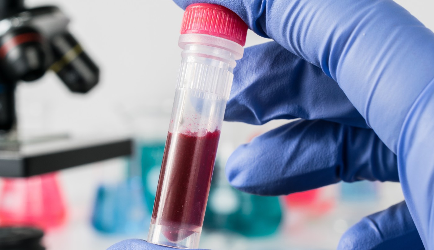 "El paciente de Ginebra": Un nuevo caso de remisión del VIH tras un trasplante de médula ósea | Internacionales