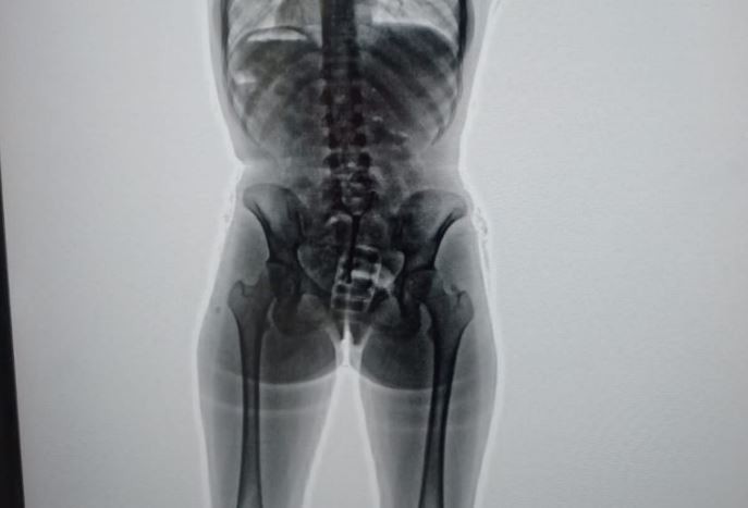 Detuvieron en Ezeiza a una mula argentina que viajaba a Europa con 78 cápsulas de cocaína en el cuerpo | Actualidad