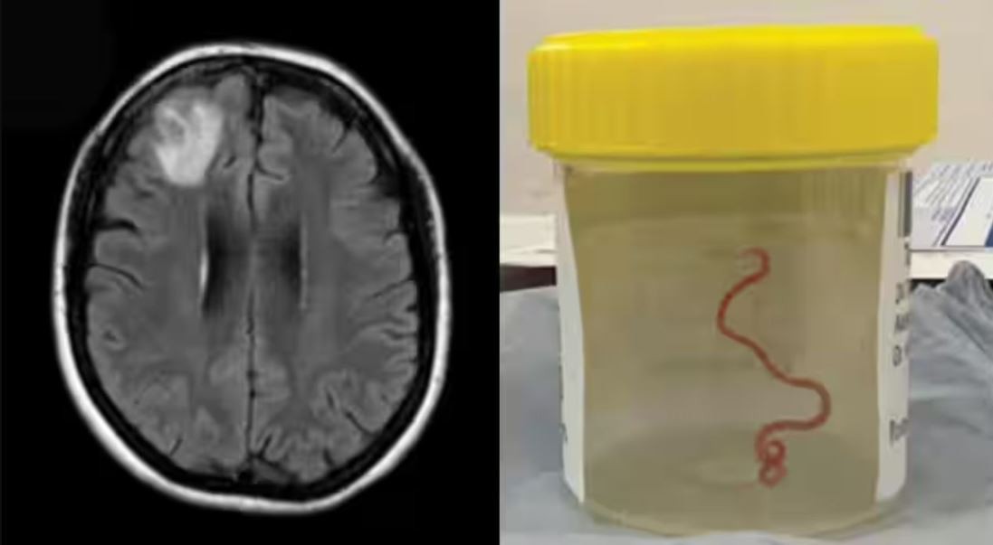 Extraen una lombriz de 8 centímetros del cerebro de una mujer | Internacionales