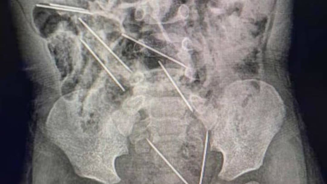 Llevó a su hijo de 2 años con fuertes dolores al hospital y tuvieron que operarlo de urgencia por lo que se había tragado | Internacionales