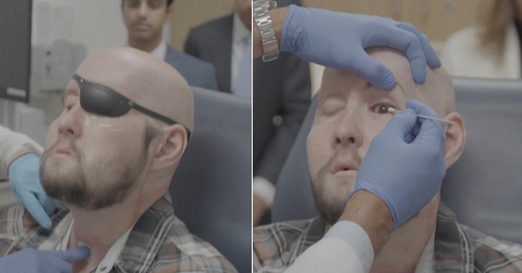 Realizaron el primer trasplante de ojo completo del mundo | Actualidad