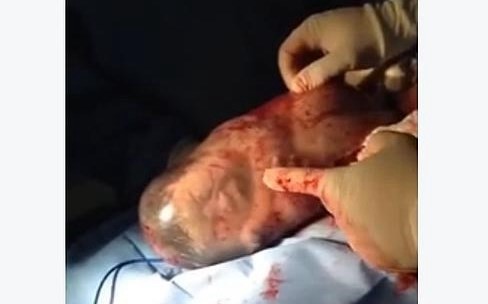 El bebé recién nacido que bosteza dentro del saco amniótico | Curiosidades