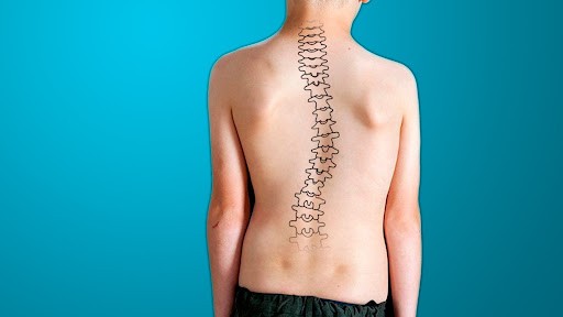 Abren inscripción para chequeos de escoliosis en el Hospital de Clínicas | Actualidad