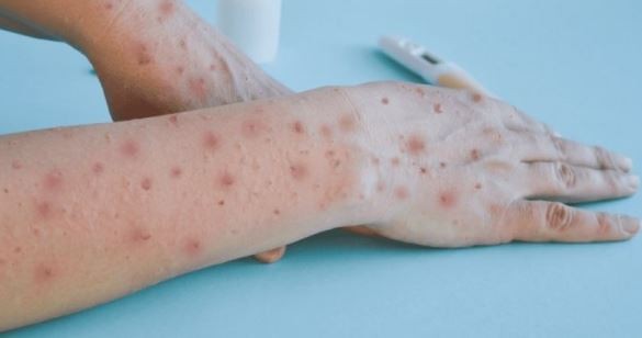 Viruela símica: España reforzará la vacunación y vigilancia ante la emergencia internacional | Internacionales