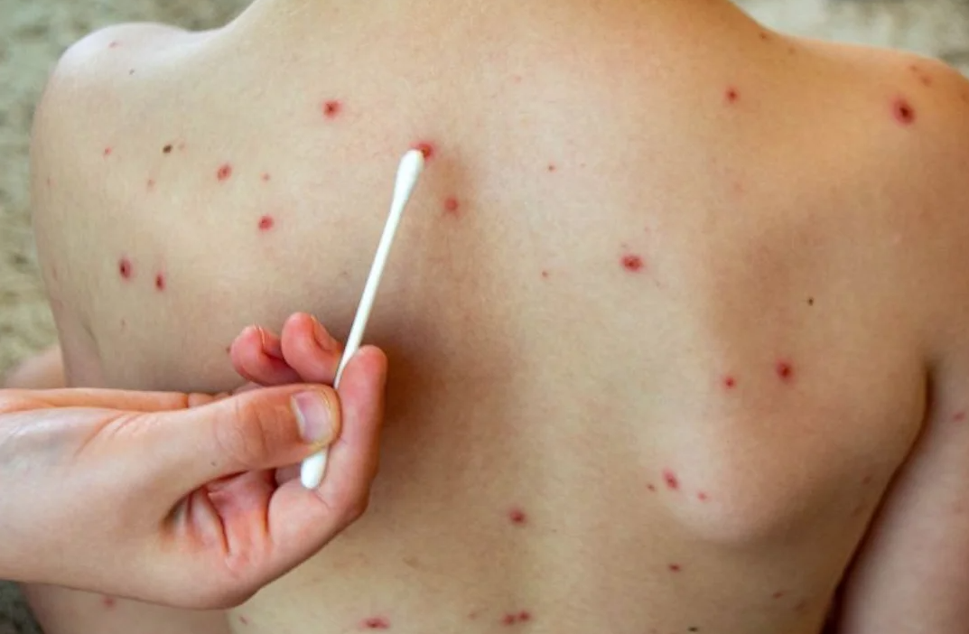 Dos casos de viruela del mono en la provincia de Buenos Aires: refuerzan controles de prevención y detección | Actualidad