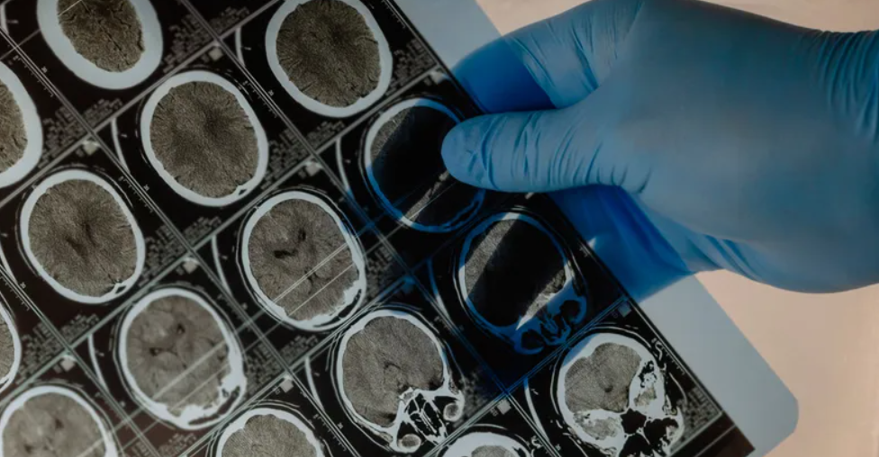 Un adolescente vive hace 5 años con un balín incrustado en la cabeza | Internacionales