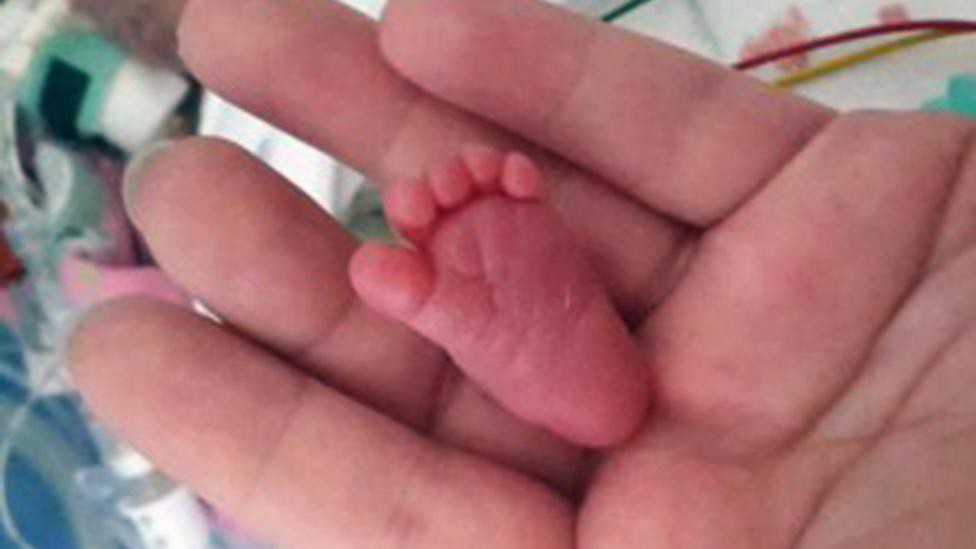 La historia de la bebé más chica del mundo | Curiosidades