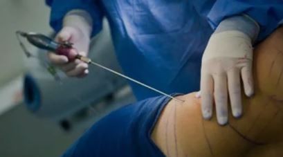 Río Negro: Denunciaron a un médico por hacerle una liposucción a su mujer sin autorización | Actualidad