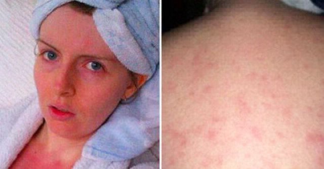 La historia de la mujer que no se puede bañar porque tiene alergia al agua | Curiosidades