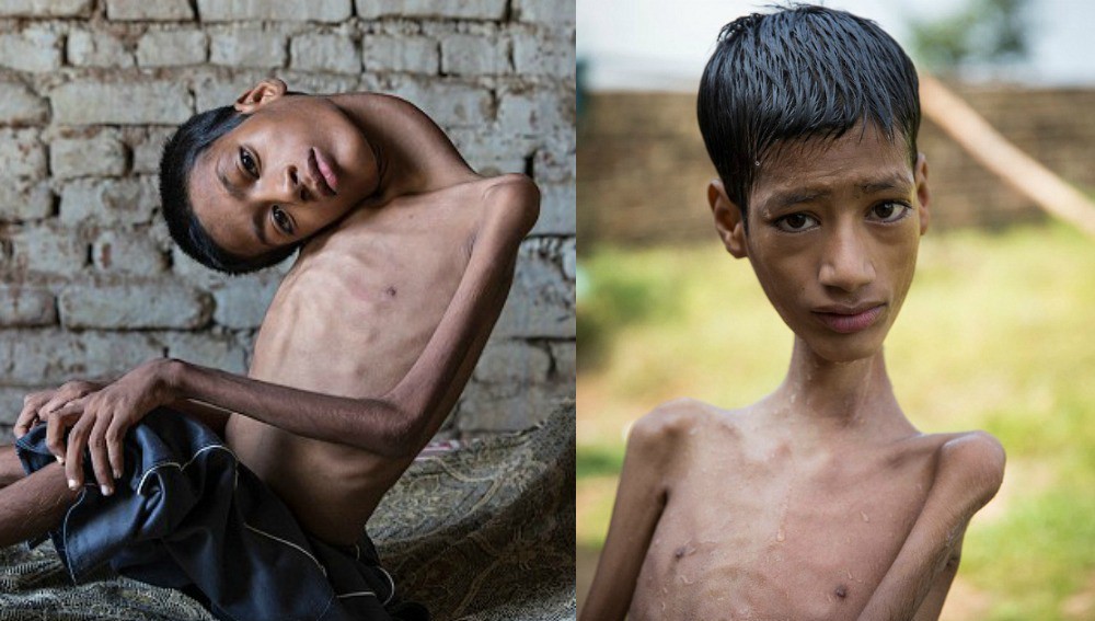 Fue operado con éxito el chico que tenía el cuello colgando | Curiosidades