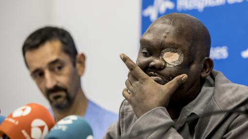 El antes y después del hombre al que le creció un tumor gigante en la cara | Curiosidades