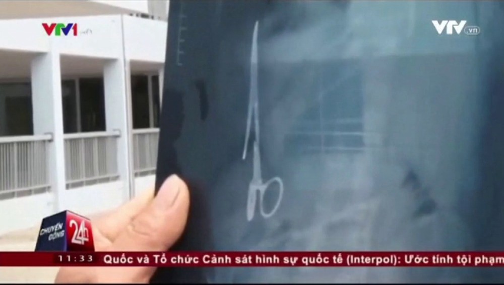 Lo operaron para sacarle una pinza quirúrgica olvidada en su estómago hace 18 años | Curiosidades