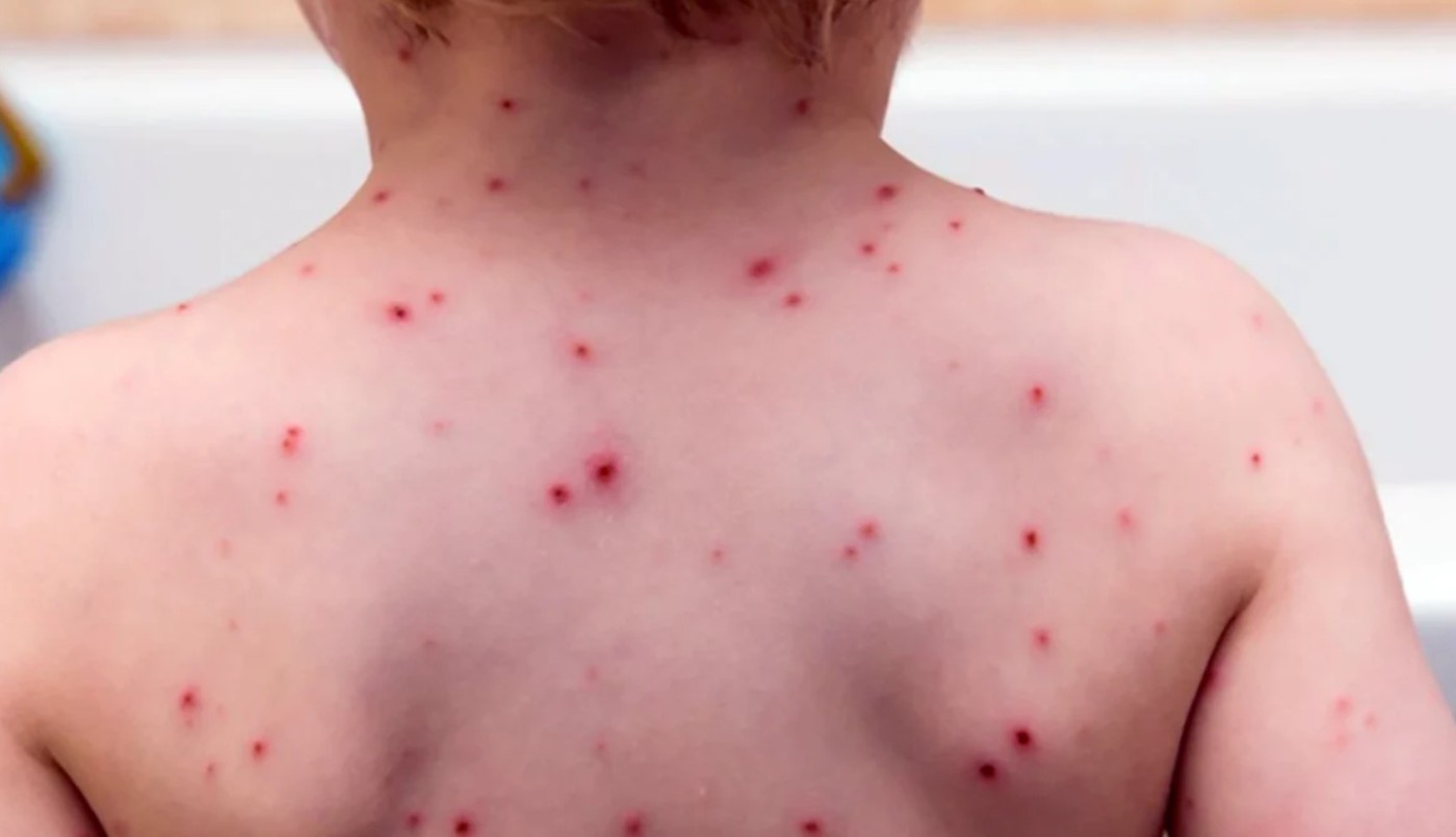 El brote de sarampión en Estados Unidos supera los 1.000 casos confirmados | Internacionales