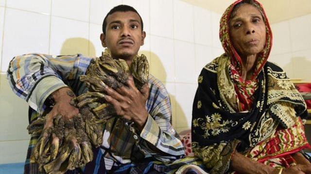 Operaron al "hombre árbol": mirá las fotos del antes y después | Curiosidades