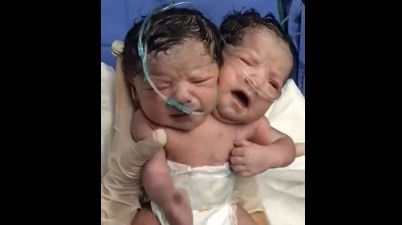 México: murió el bebé con dos cabezas | Curiosidades
