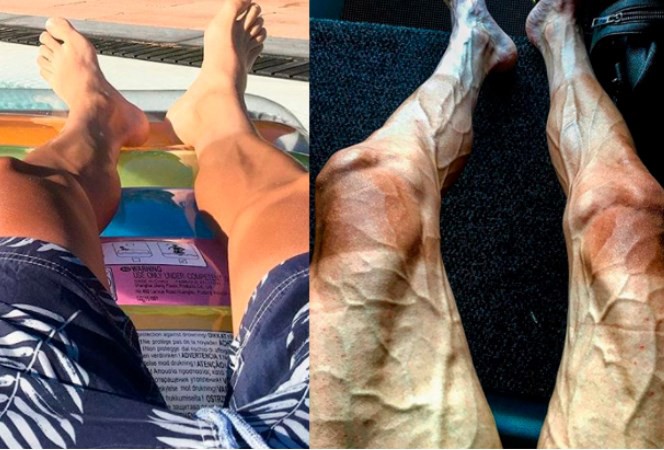 Impresionante: así quedan las piernas de un ciclista del Tour de Francia | Deportes