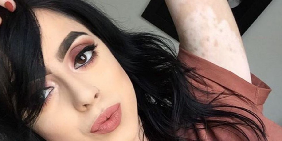 Tiene vitiligo y como respuesta a las burlas convirtió su cuerpo en arte | Curiosidades