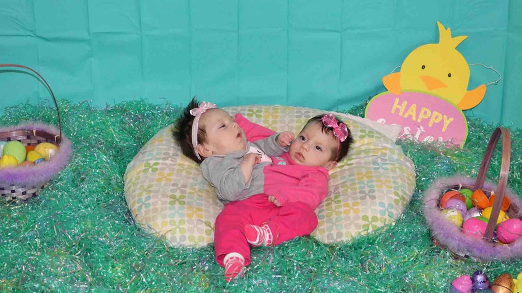 Los padres que están orgullosos de sus gemelas, pese a que los médicos les aconsejaron abortar | Curiosidades