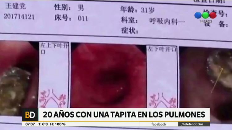 Tosió sangre y descubren una tapita de lapicera que llevaba 20 años en sus pulmones | Curiosidades
