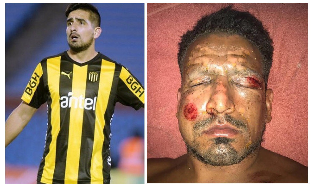 Dos meses de recuperación tendrá Lucas Viatri tras el accidente con pirotecnia | Deportes