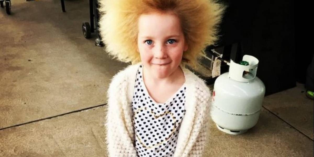 La extraña enfermedad que sufre una nena que no puede peinarse | Curiosidades