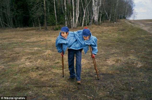 La increíble historia de las siamesas soviéticas que vivieron unidas hasta los 53 años | Curiosidades