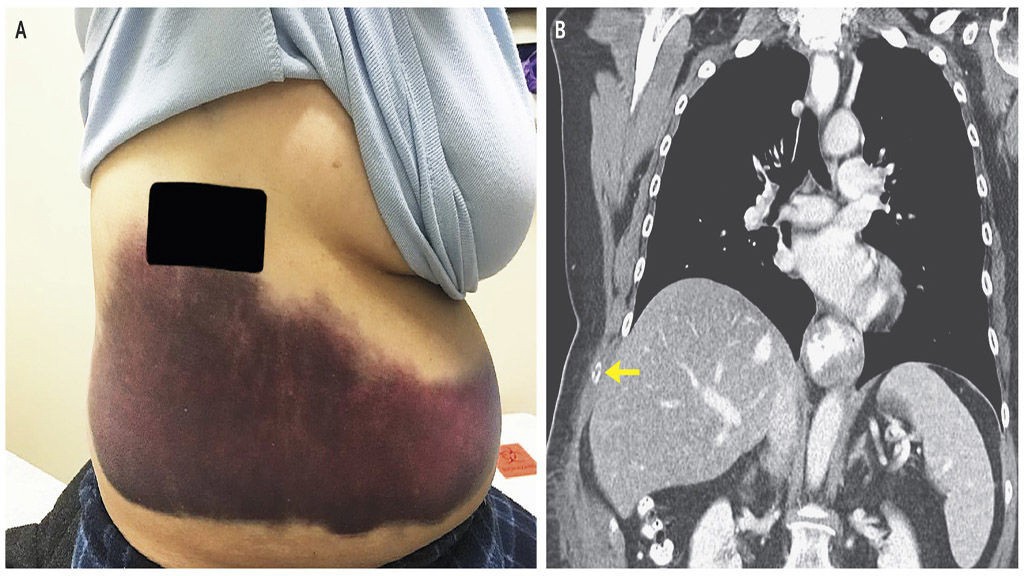 Una mujer se quebró una costilla al sufrir un ataque de tos | Curiosidades