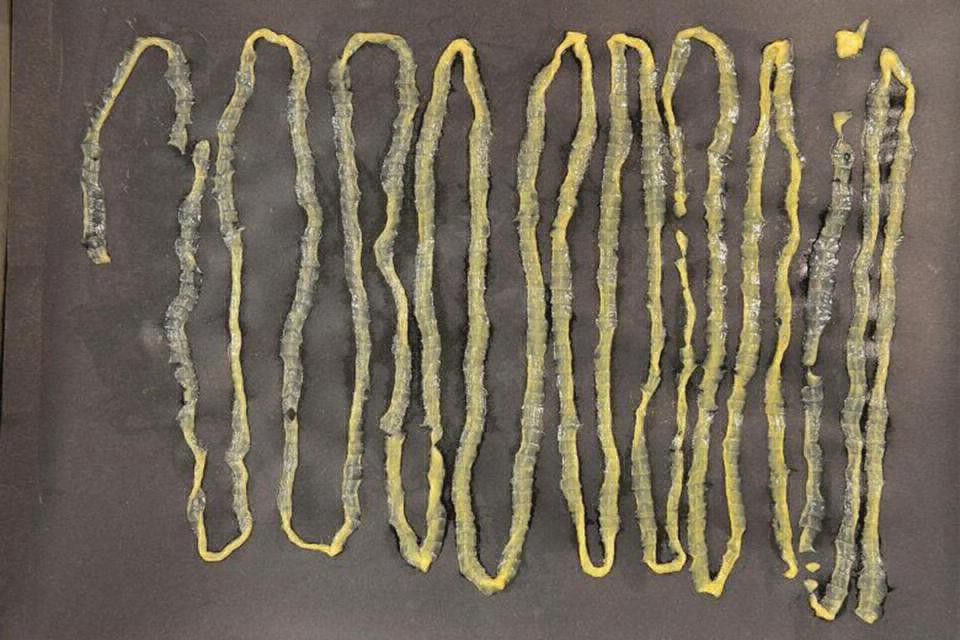 Singapur: el paciente que se sorprendió al ver la lombriz parásito que sacaron de su intestino | Curiosidades