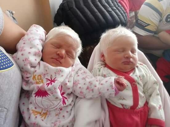 El curioso caso de las mellizas albinas que nacieron en Tucumán | Curiosidades