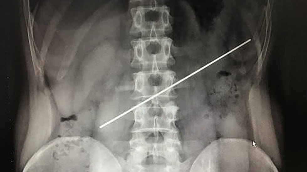 Lo operaron para sacarle una vara de acero que se tragó durante una apuesta | Curiosidades