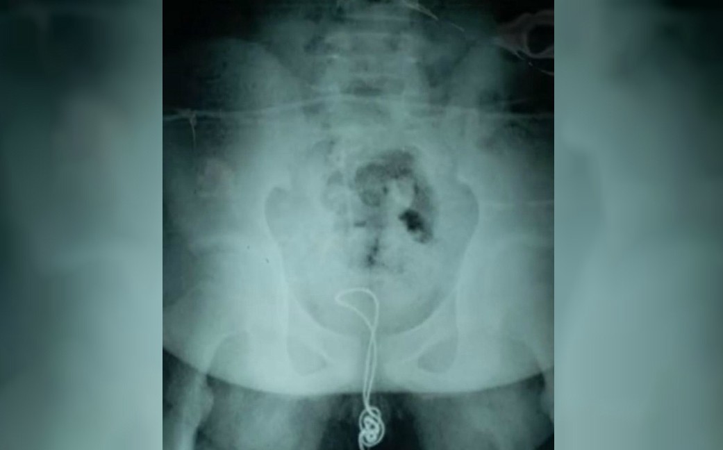 Un joven chino se metió un cable USB por el pene y tuvo que ser operado | Curiosidades