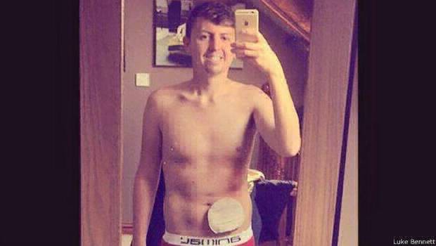 Con 20 años, mostró su bolsa de colostomía en una "selfie" y se volvió viral en la web | Internacionales