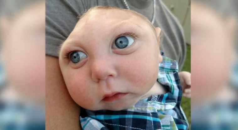 Les aconsejaron abortar, su hijo nació con medio cráneo y ahora festejaron su primer cumpleaños | Internacionales