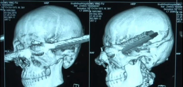 Se recupera luego de que una barra de metal le atravesó la cabeza | Internacionales