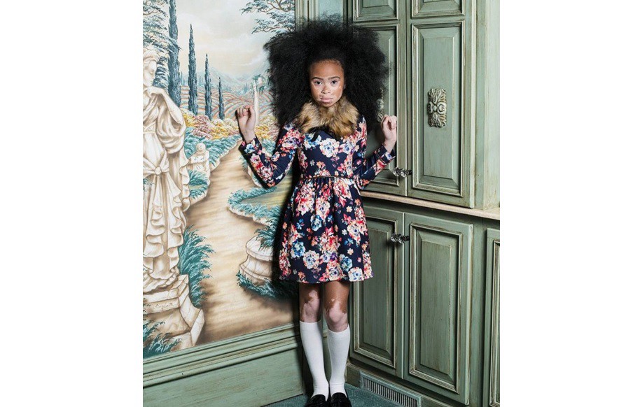 La modelo de 10 años que tiene vitiligo y busca redefinir el concepto de belleza | Internacionales