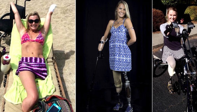 Una bacteria carnívora le devoró medio cuerpo | Internacionales