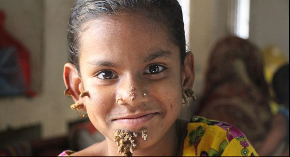 Dramático: a una nena de 10 años  diagnosticaron la "enfermedad del hombre árbol" | Internacionales