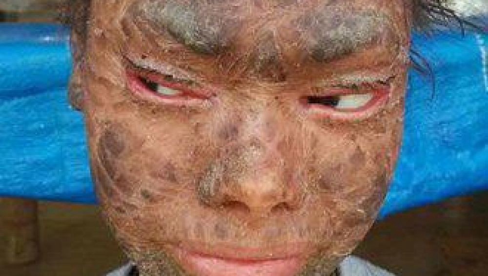 Juntan fondos para el tratamiento de la "adolescente serpiente" que cambia de piel cada 45 días | Internacionales