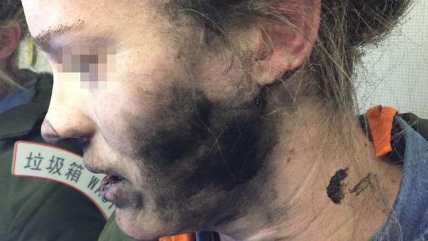 Así quedó la mujer a la que le explotaron los auriculares durante un vuelo | Internacionales